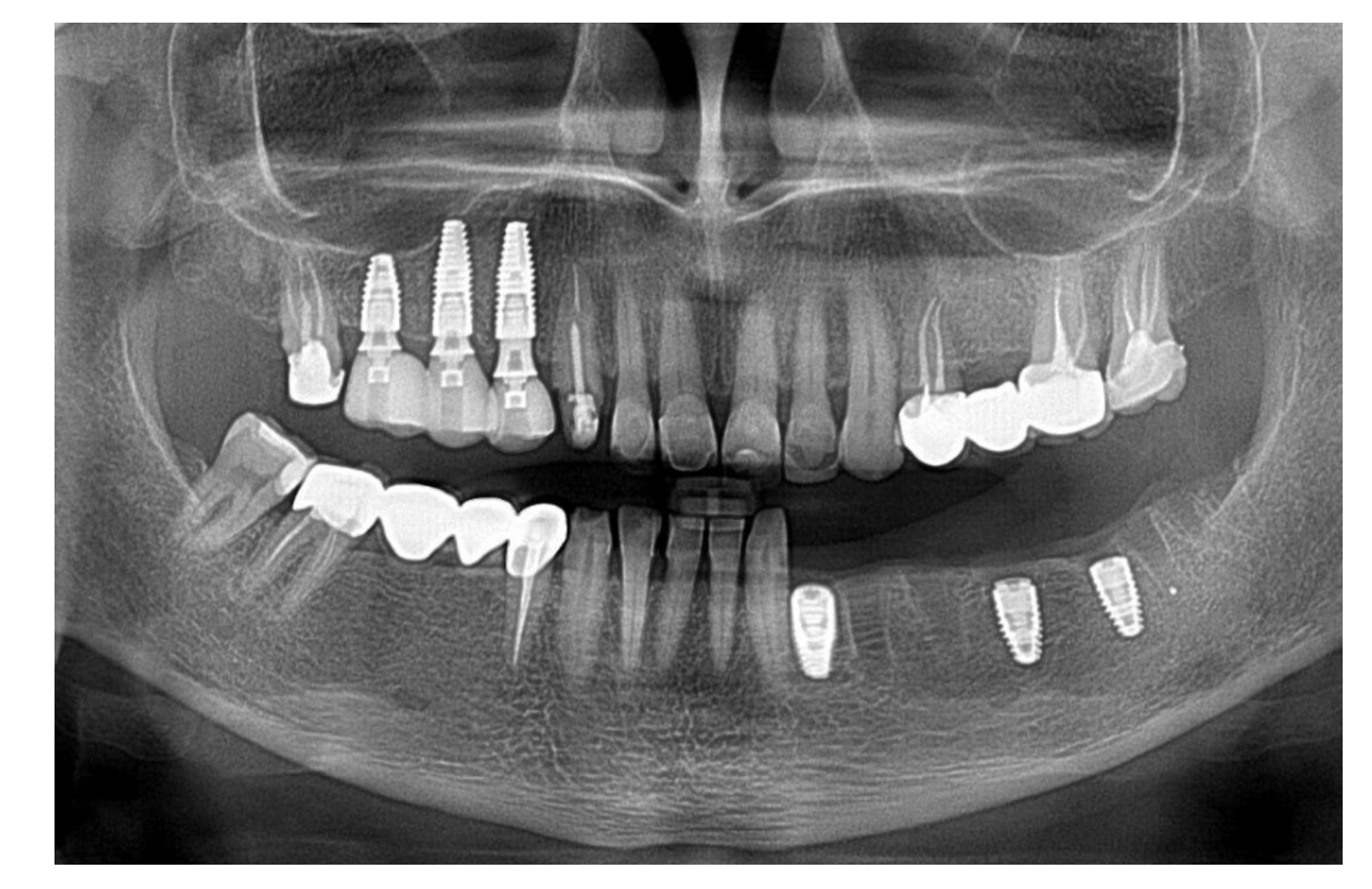 Panoramic view of implant-supported restorations Panoramic radiograph showing dental implants and mixed prosthetic restorations across both jaws.