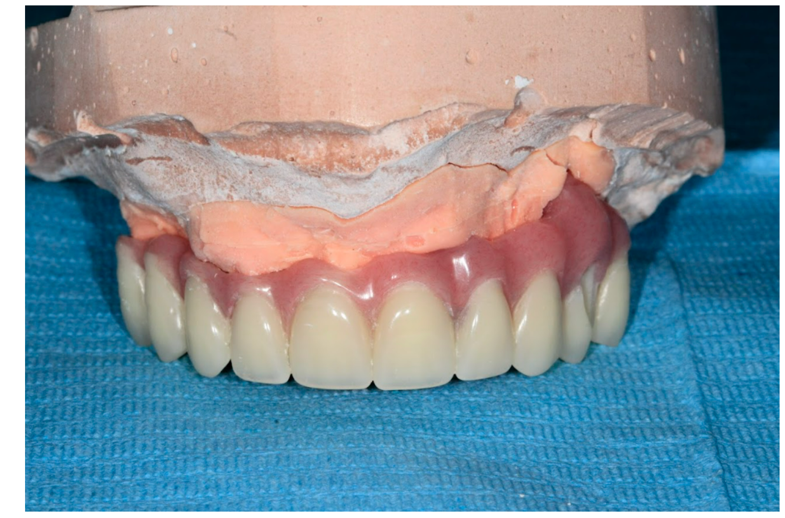 3D-printed PMMA full-arch restoration Full-arch PMMA prosthesis seated on a plaster cast model.