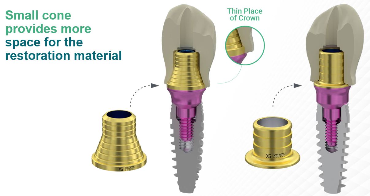Reduced-taper abutment increases crown thickness Diagram showing how a reduced abutment cone leaves more space for restorative material at the thin crown margin.