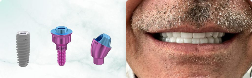 Bimaxillary Full-Arch Rehabilitation: A Fully Digital, Screw-Retained Protocol Utilizing V-Type and D-Type Multi-Unit Abutments