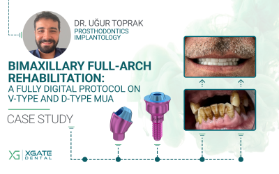 Bimaxillary Full-Arch Rehabilitation: A Fully Digital, Screw-Retained Protocol Utilizing V-Type and D-Type Multi-Unit Abutments
