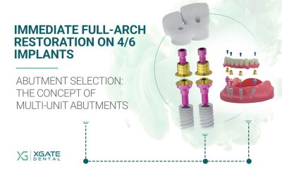 Immediate Full-Arch Restoration on 4/6 Implants. Part 3
