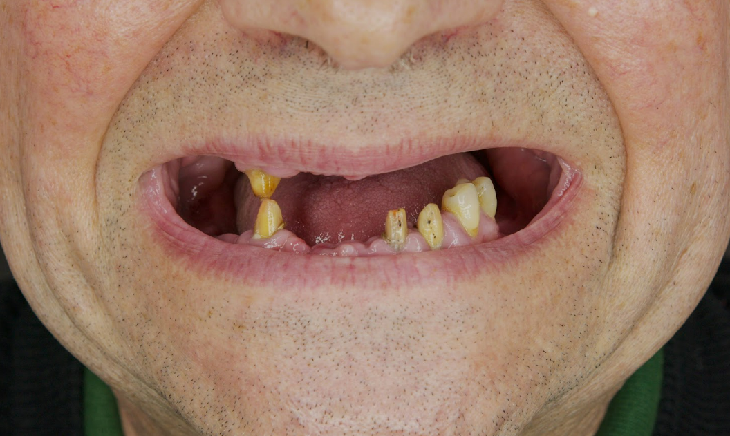Complex clinical case Patient with multiple missing and damaged teeth in the lower jaw before complex restoration.