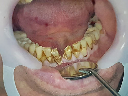 Crowns installed on implatates 20 years ago