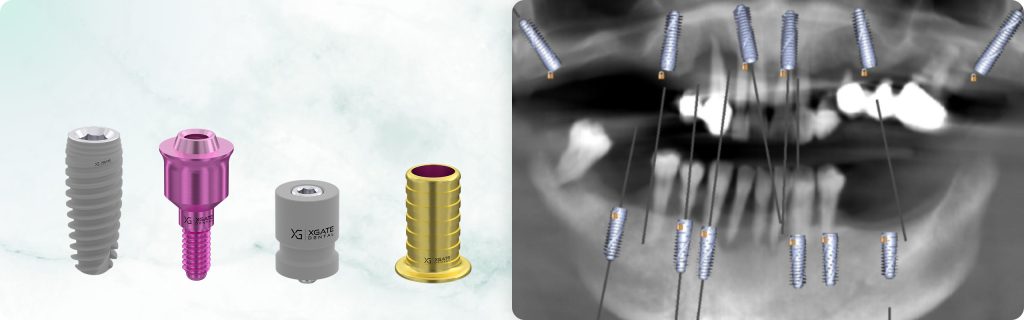 Full-Arch Rehabilitation of the Maxilla and the Mandible Using a Digital Protocol and Superstructures by XGATE Dental