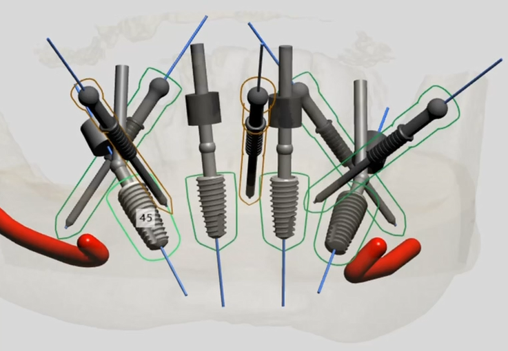 Cross-sectional view showing four dental implants with angled abutments positioned in mandibular bone