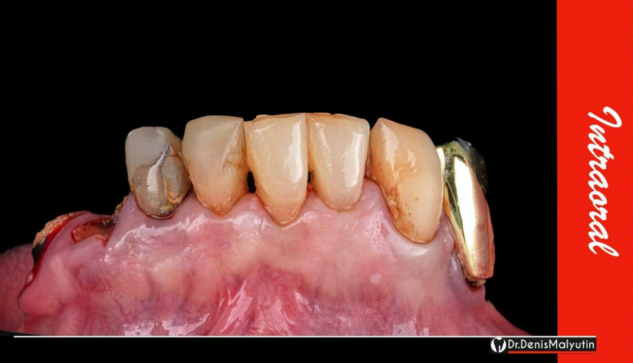 Dental model showing angled abutment with metal framework on mandibular anterior teeth