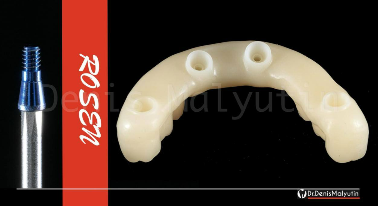 Mandibular dental prosthesis with four angled abutment attachment holes and metal implant component