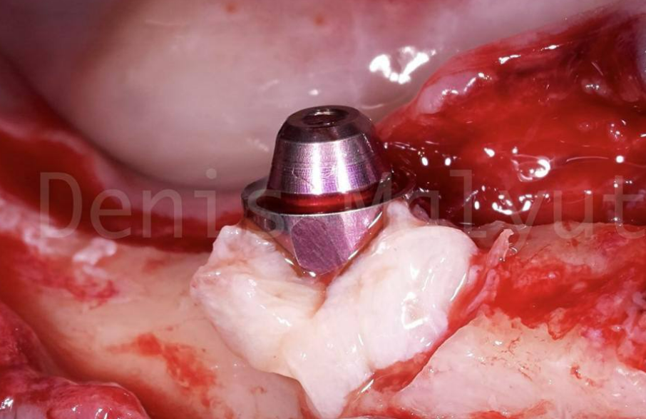 Angled abutment secured on dental implant in mandible with surrounding bone graft material