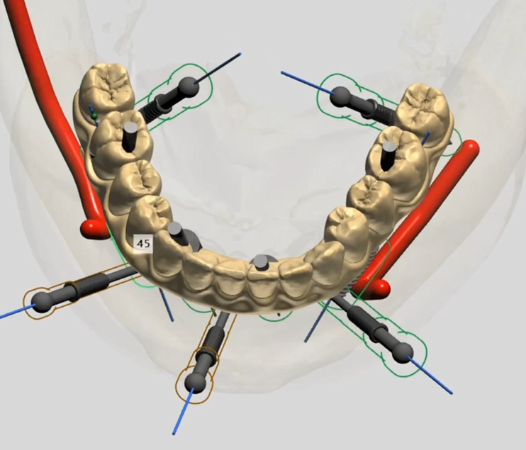 Digital dental model showing multiple angled abutments positioned in mandibular arch with directional indicators