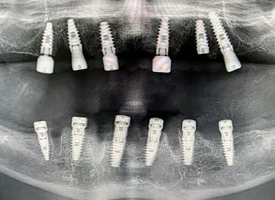 Bimaxillary Full-Arch Rehabilitation: A Fully Digital, Screw-Retained Protocol Utilizing V-Type and D-Type Multi-Unit Abutments