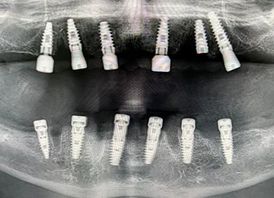 Bimaxillary Full-Arch Rehabilitation: A Fully Digital, Screw-Retained Protocol Utilizing V-Type and D-Type Multi-Unit Abutments