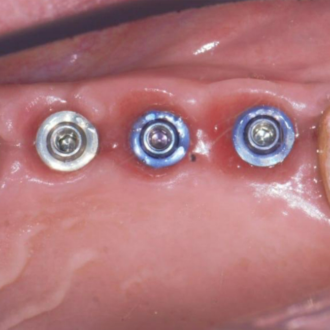Replacing an old bridge with a new restoration supported by implants and XGATE Dental V-Type abutments