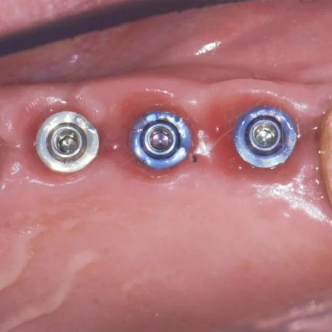 Replacing an old bridge with a new restoration supported by implants and XGATE Dental V-Type abutments