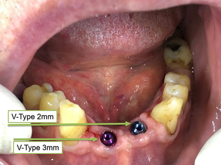 A photo of the lower jaw with multi-unit installed