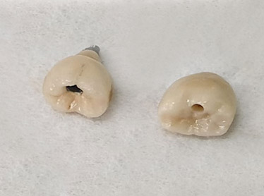 Crowns removed from previously installed implants