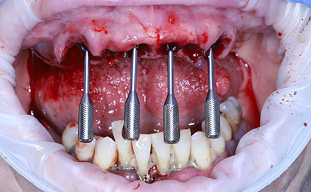Treatment process