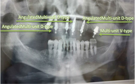 X-ray