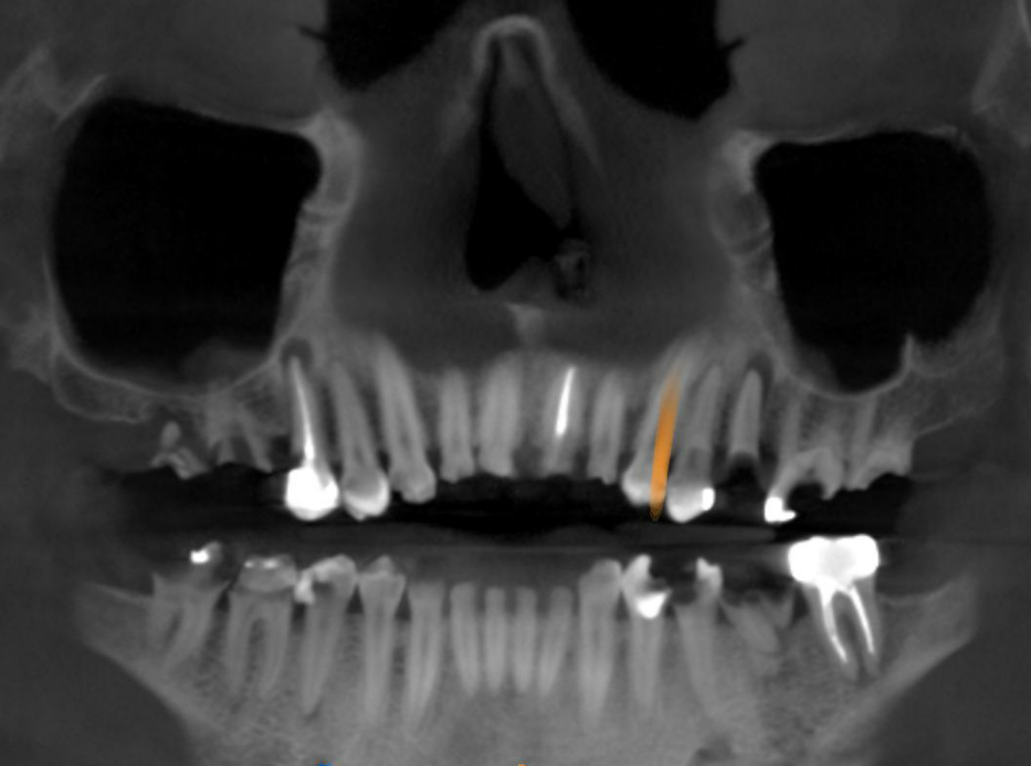Coronal CBCT view detailing initial bone level, remaining dentition, and implant planning considerations.