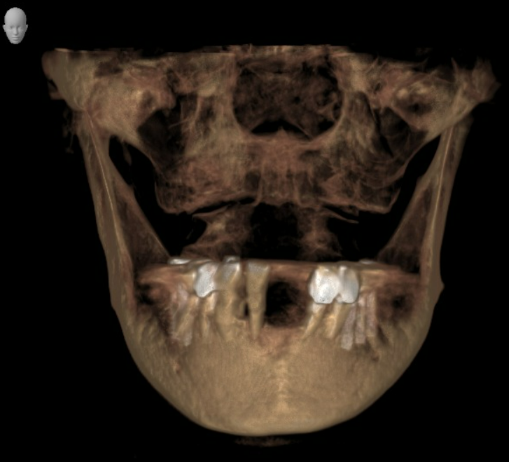 3D rendering of a human jaw based on CBCT scan, used for diagnostic planning in dental implant treatment.