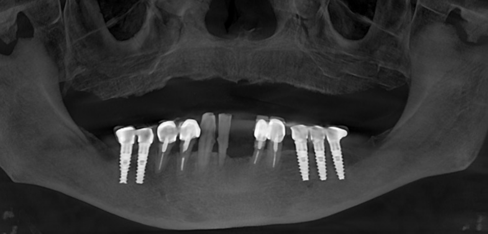Panoramic X-ray showing full mandibular rehabilitation with dental implants for a patient case study