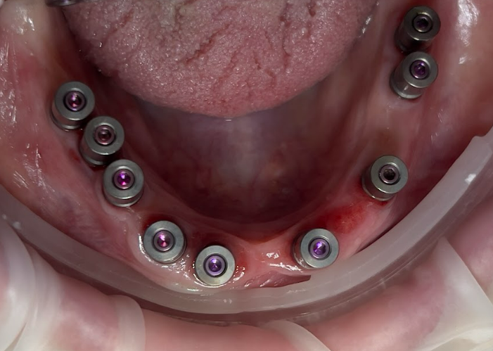 Clinical view of a dental arch with healing caps placed on multiple dental implants to protect them and shape the gums during the healing phase