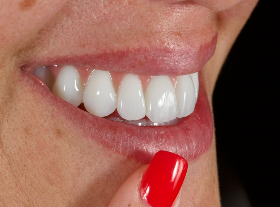 Final treatment result showing patient smile with full-arch maxillary zirconia restoration demonstrating excellent aesthetics