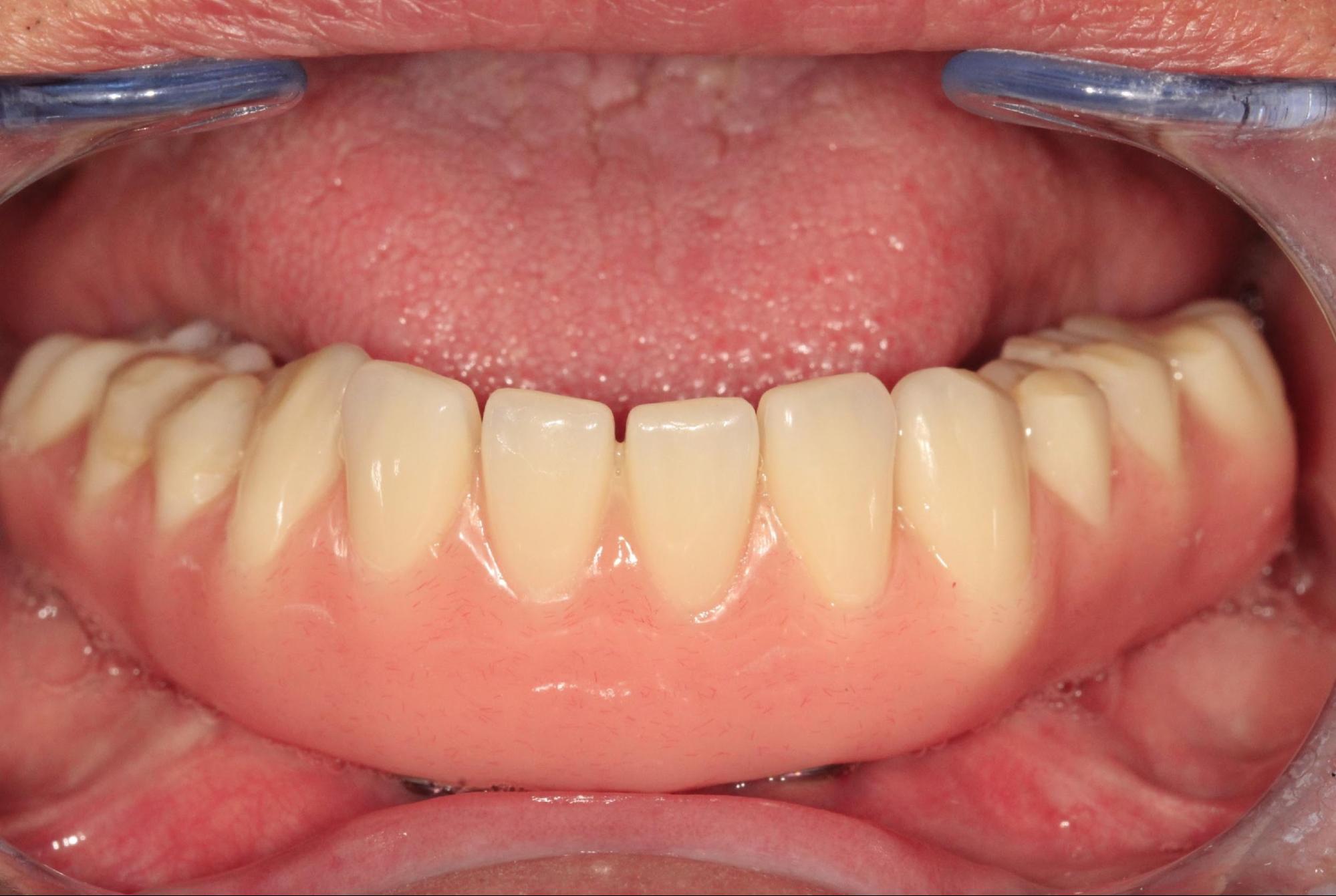 The final mandibular prosthesis seated in the patient’s mouth, showing excellent esthetics and fit after the reline procedure.