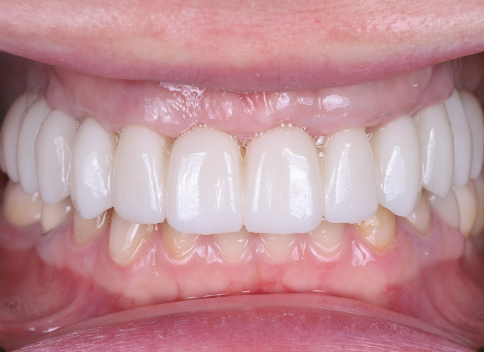 Close-up view of completed porcelain veneers on upper front teeth showing natural white restoration