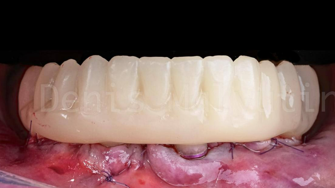 Complete fixed dental prosthesis with Rosen conical screw retention on mandibular arch
