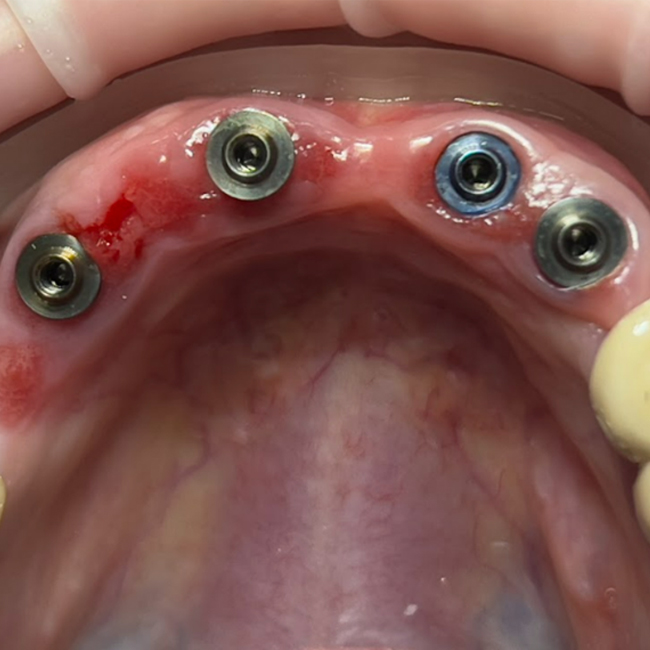 Full-Arch Restoration of Maxillary and Mandibular Arches with Mandibular Tooth Extraction: Screw-Retention on V-type and D-type Multi-Unit Abutments by XGate Dental
