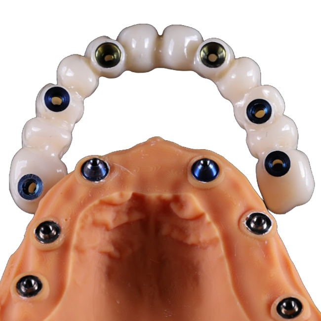 Total Maxillary Rehabilitation: Fixation of a Zirconia Prosthesis on V-Type and D-Type Multi-Unit Abutments