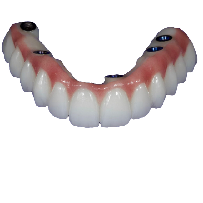 Full-Arch Restoration of the Maxilla Using a Digital Protocol and Ultra-Compact XGATE Dental V-Type Multi-Units