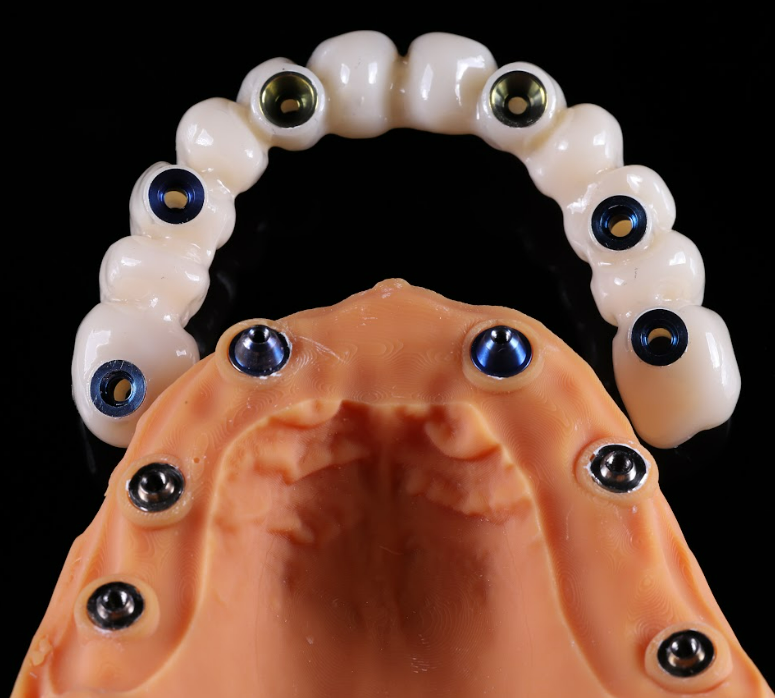 Dental implant supported full arch zirconia restoration on gingival model with abutments