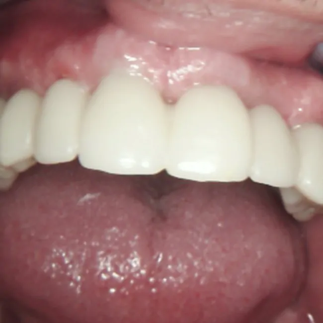 Full Maxillary and Partial Mandibular Rehabilitation Using XGATE Dental Multi-Unit Abutments and Implants