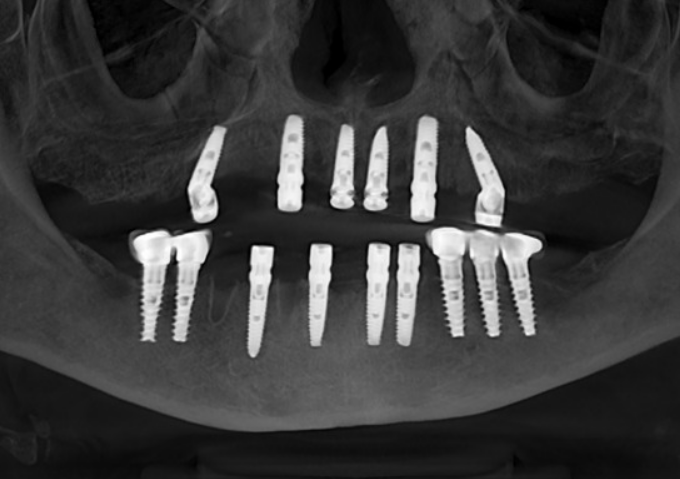 Post-operative panoramic X-ray showing the final placement of full-mouth dental implants in both the maxillary and mandibular arches