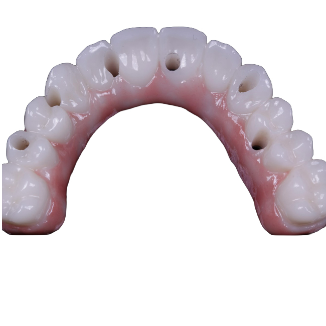 Full-Mouth Rehabilitation. Screw-retained MUA by XGATE