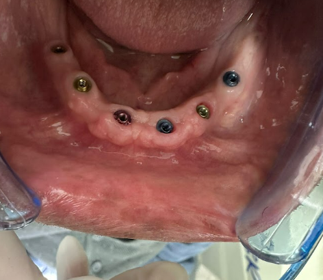 Occlusal view of the mandible with healed gingiva and six seated multi-unit abutments.