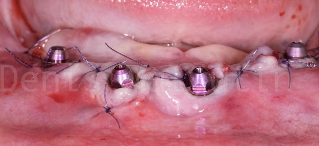 Four healing abutments placed on mandibular implants with sutures around gingival tissue