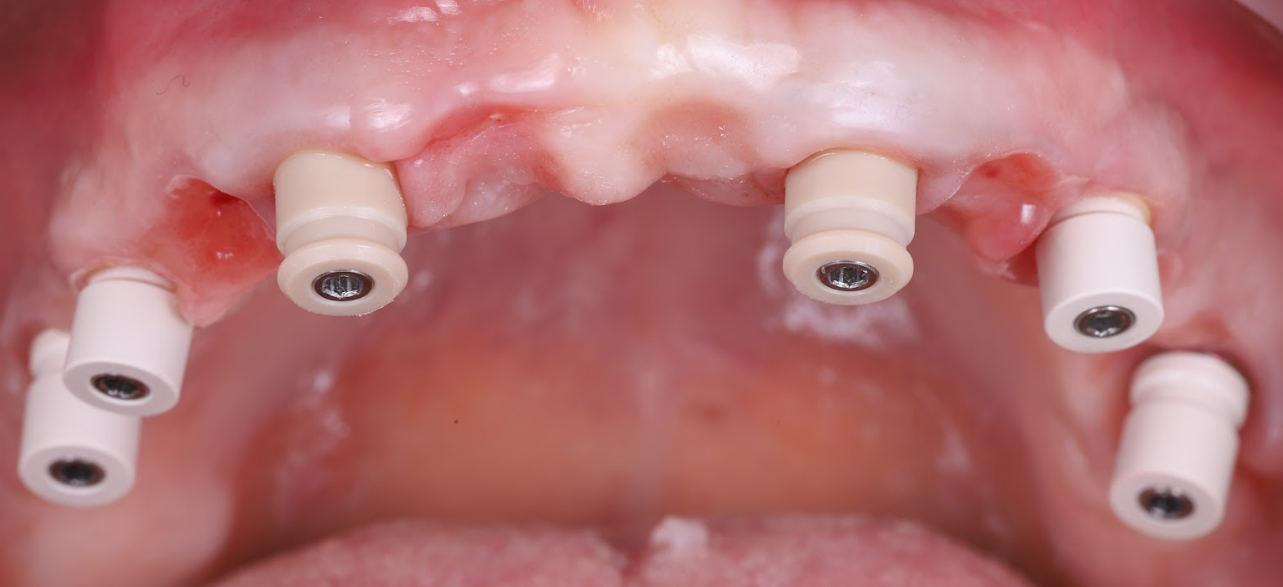 Six white healing abutments installed in upper jaw dental implant sites
