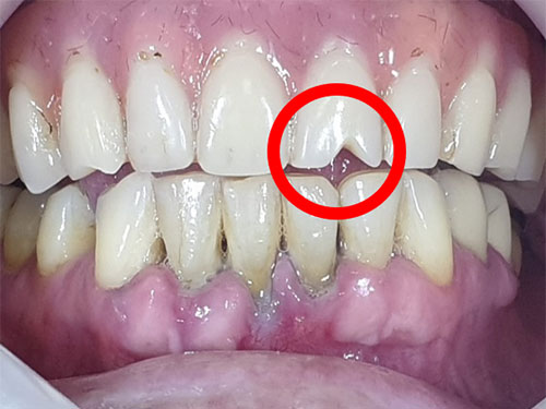 Immediate loading on the lower frontal teeth