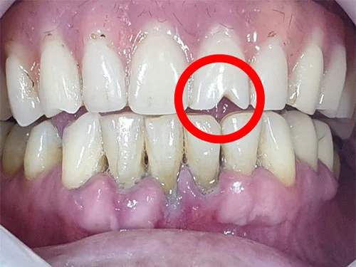 Immediate loading on the lower frontal teeth