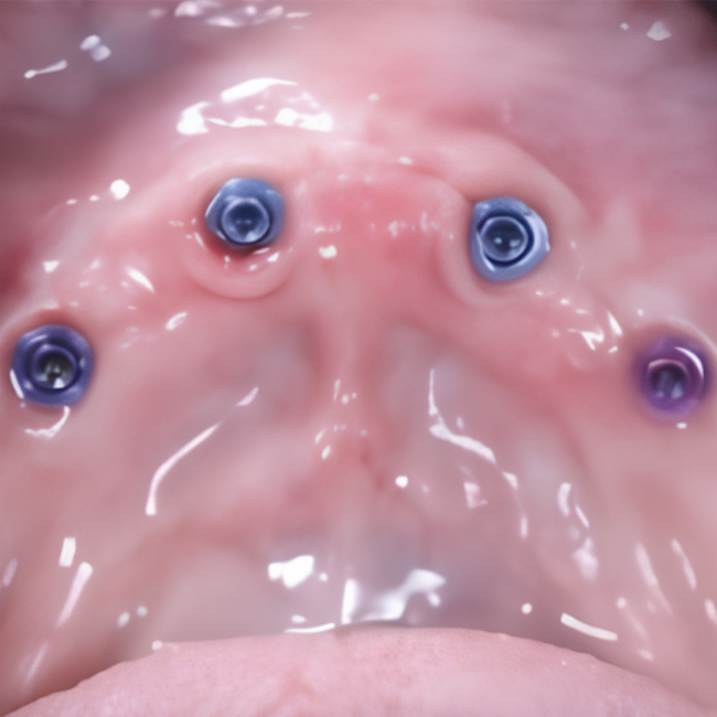 Total Mandibular Bar Restoration: Screw Retention Using MUA V-Type with Ultra Low Profile