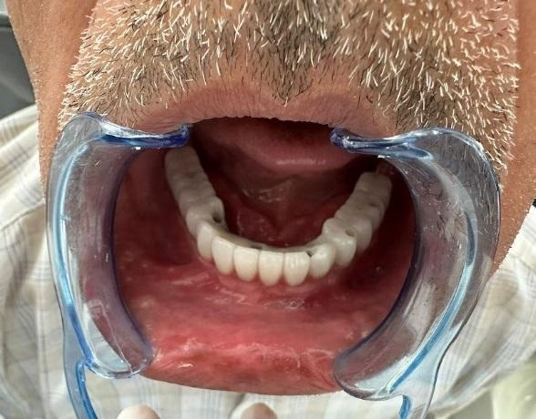 Frontal view of the mandibular full-arch prosthesis seated on the multi-unit abutments.
