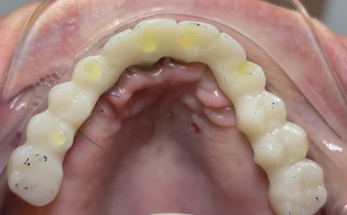 Clinical photo showing a temporary prosthesis installed in the anterior region of the mandible, with existing bridges maintained in the posterior regions