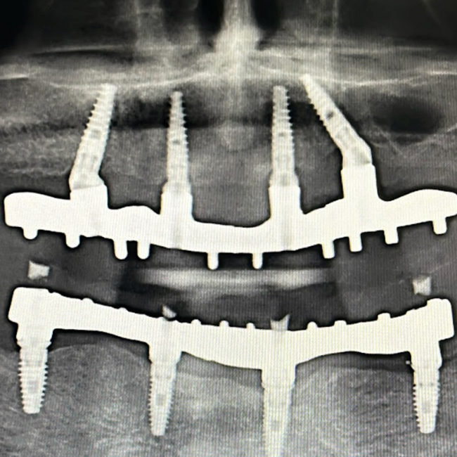 Total Rehabilitation of the Maxilla: a Screw-Retained Prosthesis Using Implants and MUAs by the German Brand XGATE