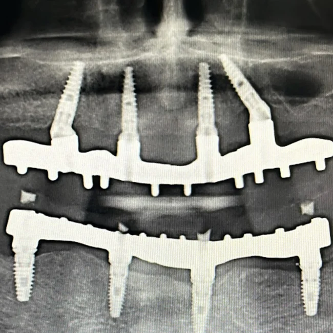 Total Rehabilitation of the Maxilla: a Screw-Retained Prosthesis Using Implants and MUAs by the German Brand XGATE