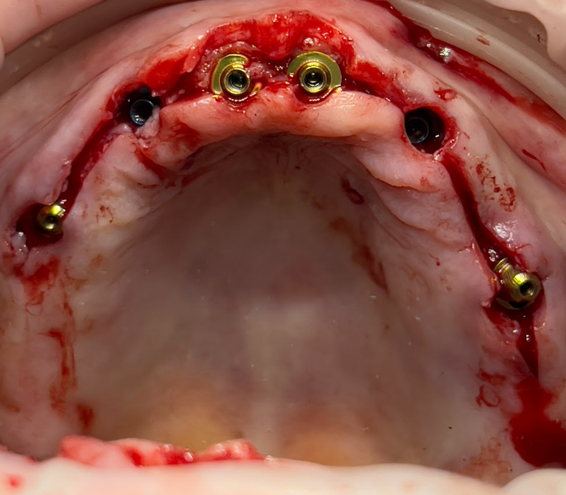 Intraoral photograph of the maxillary arch post-surgery, with scan bodies attached to dental implants to digitally record their positions for prosthetic fabrication