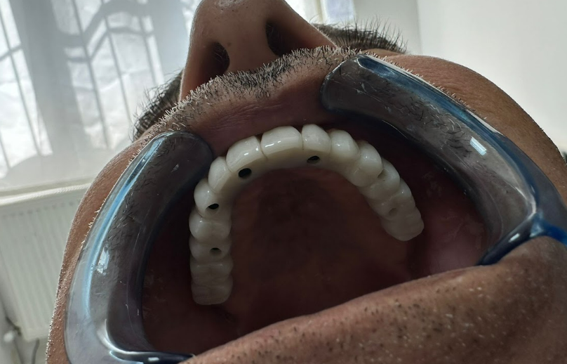 Occlusal view of the screw-retained maxillary prosthesis seated in the mouth.