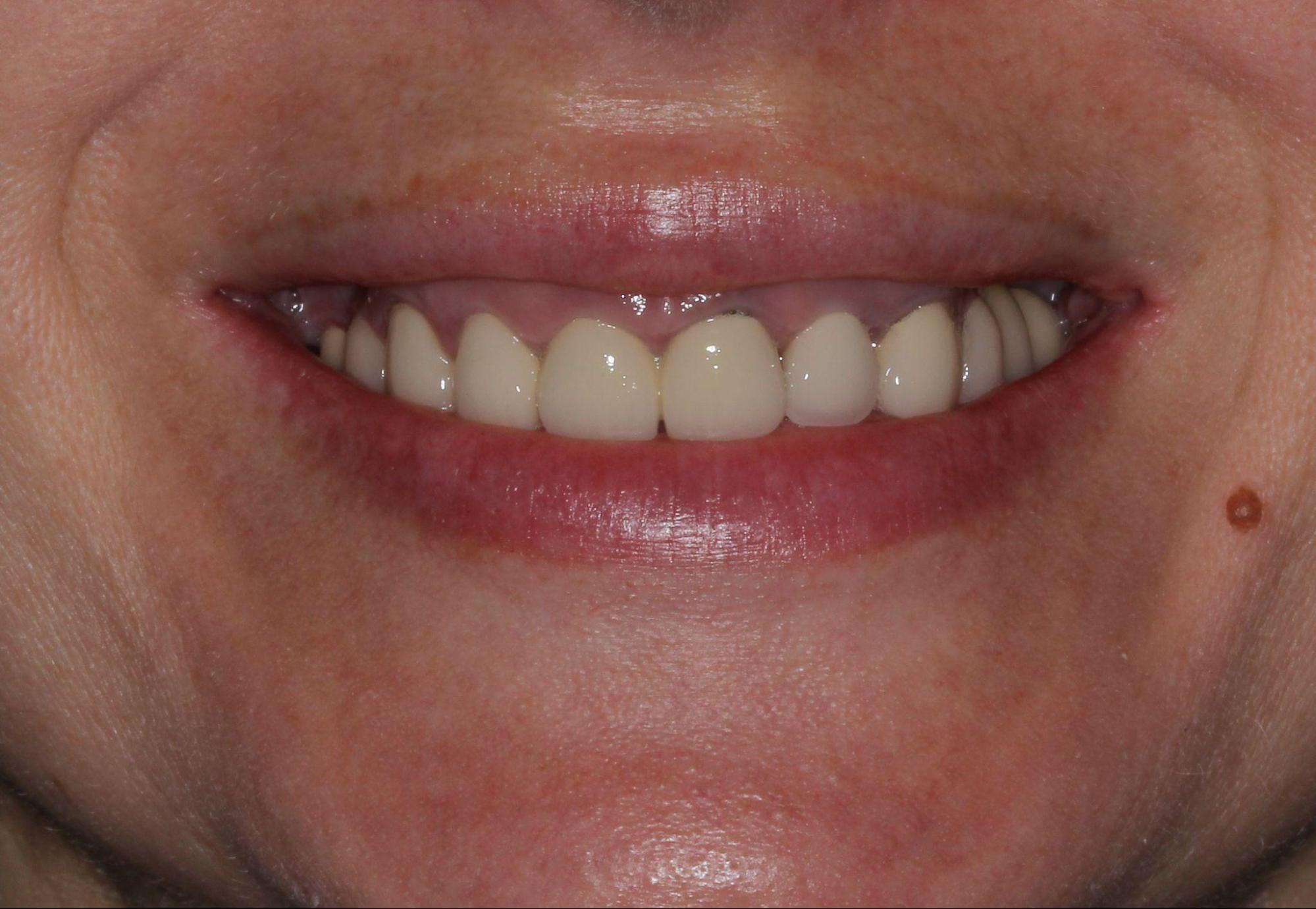 Close-up of patient's natural-looking smile showing restored upper and lower teeth after dental implant treatment